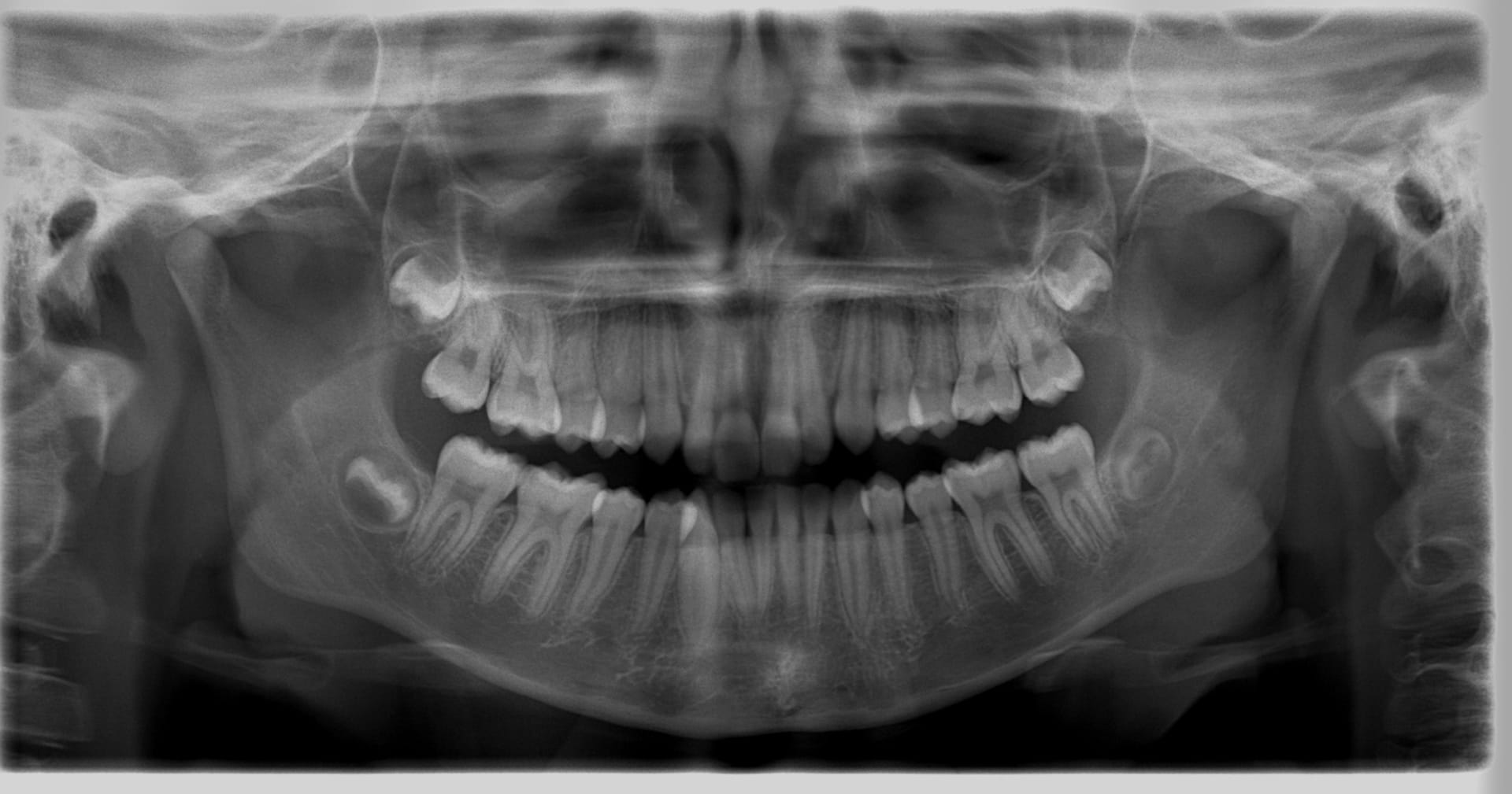 Root Canal Treatment