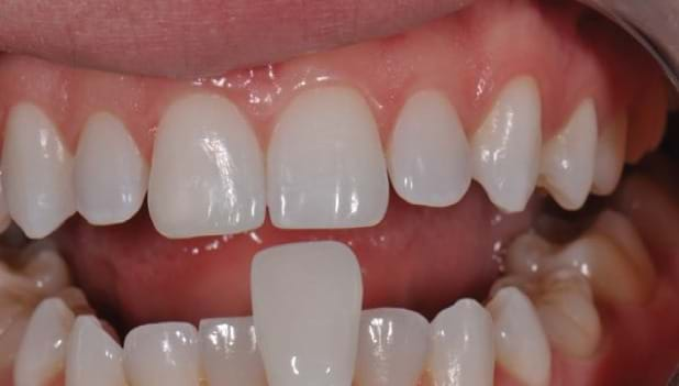 More Information About Veneers Precess