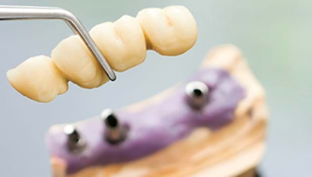 Five Things You Need To Know About Getting A Dental Crown