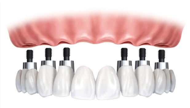 Dental Implants